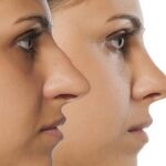 آیا ژنتیک روی استخوانی بودن بینی تاثیر دارد؟
