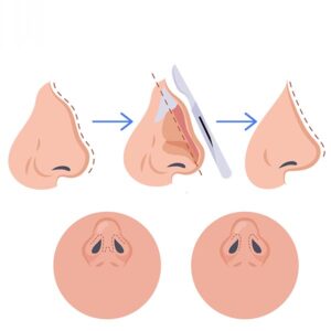 جراحی انحراف بینی مردانه