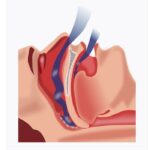 عوارض خطرناک آپنه خواب یا قطع تنفس در خواب