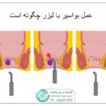 عمل لیزر بواسیر چگونه است + نظرات کسانی که تجربه عمل داشتند