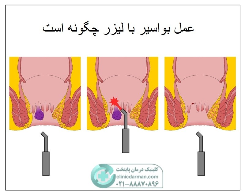 عمل لیزر بواسیر چگونه است + نظرات کسانی که تجربه عمل داشتند