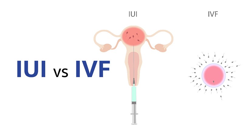 آی یو آی( IUI ) یا آی وی اف ( IVF ): کدامیک برای شما مناسب است