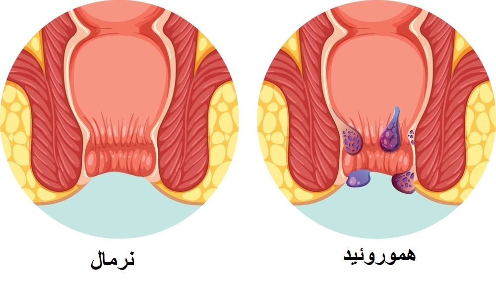 بواسیر چیست