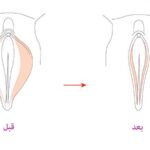 چرا زنان باید عمل لابیاپلاستی انجام دهند؟