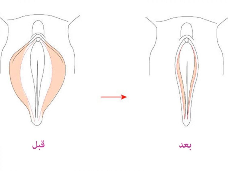 چرا زنان باید عمل لابیاپلاستی انجام دهند؟