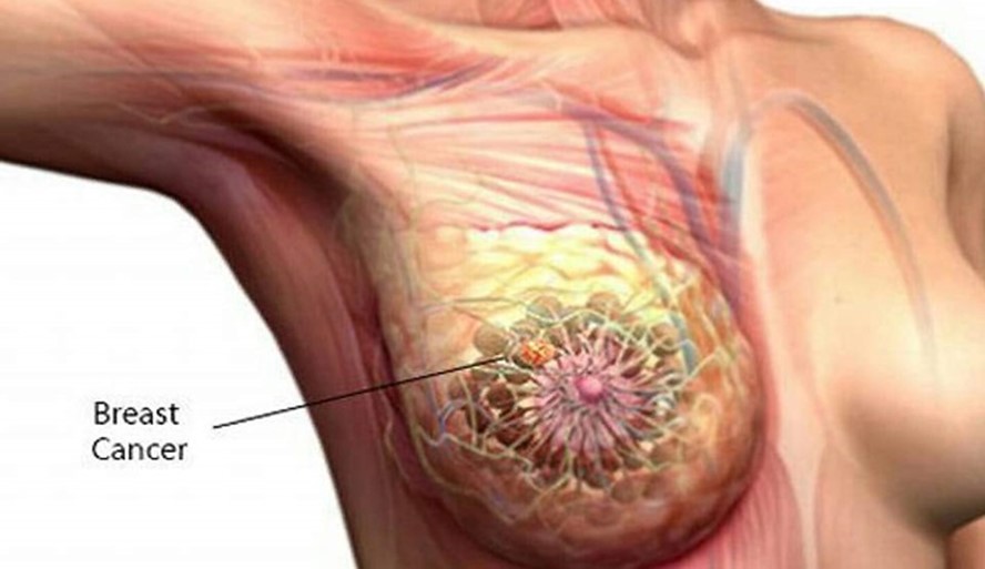 علائم سرطان پستان و پاسخ به پرسش‌های رایج