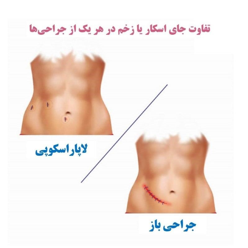 مزایای لاپاراسکوپی 
