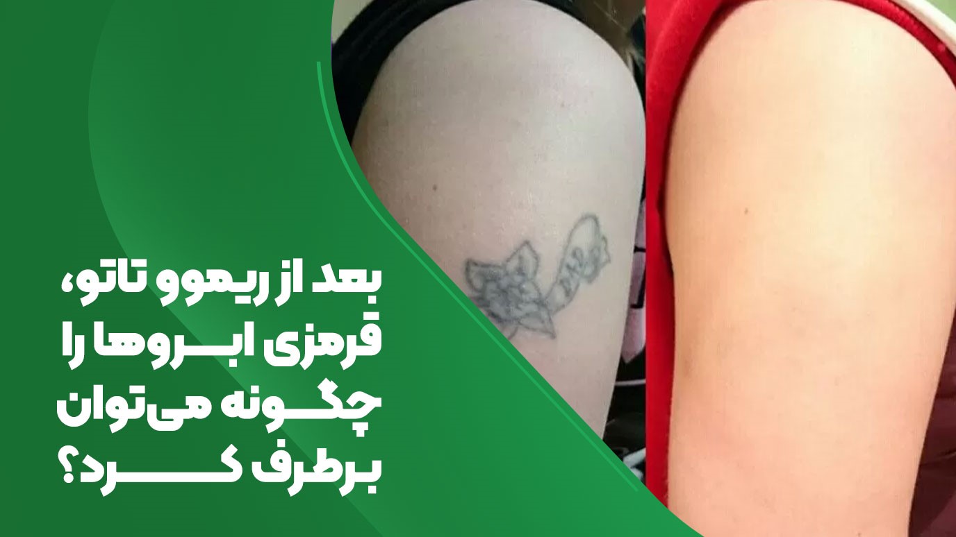 تصویر بعد از ریموو تاتو قرمزی رو چجوری از بین ببریم 
