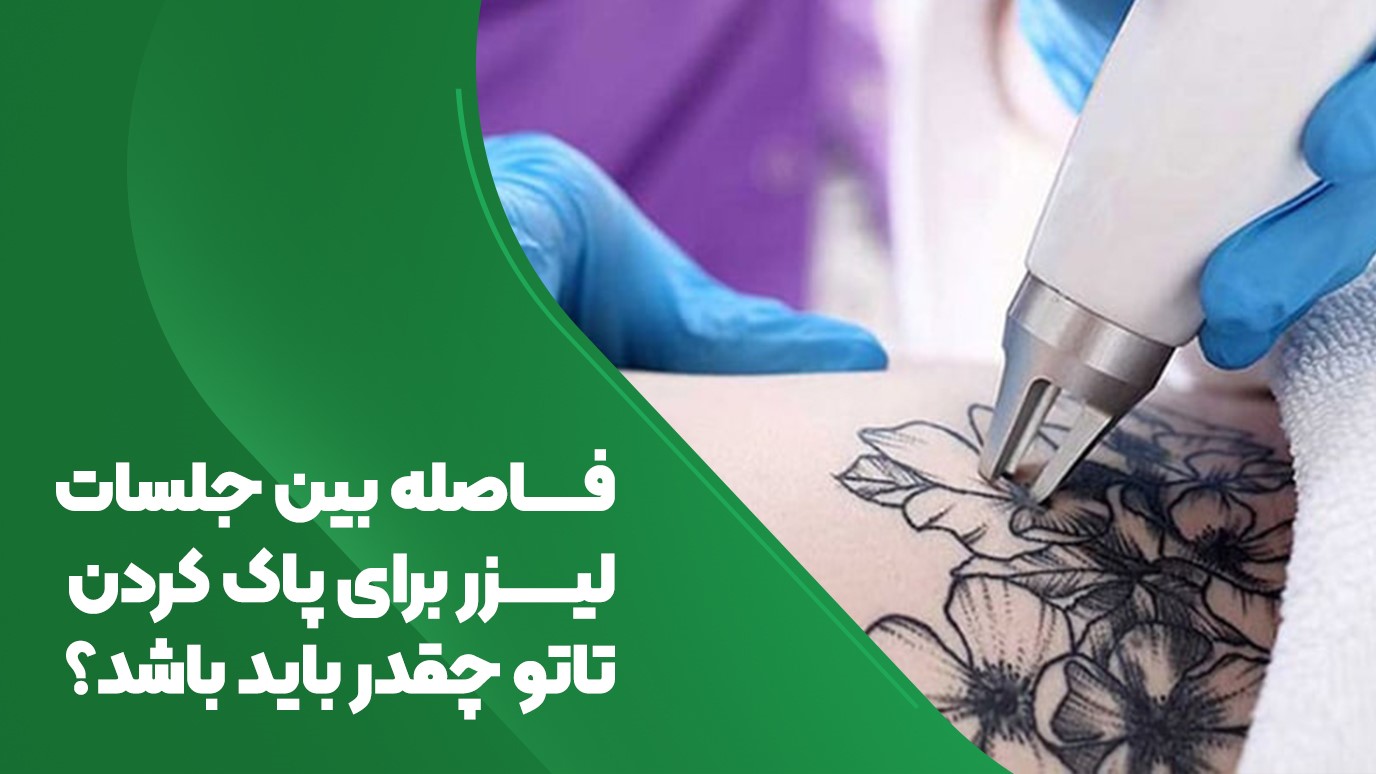 فاصله جلسات لیزر برای پاک کردن تاتو 
