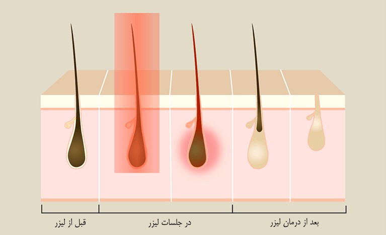 لیزر موهای زائد 