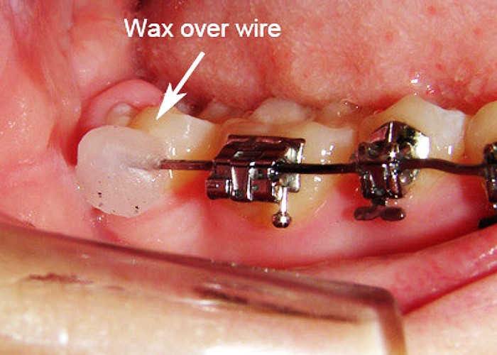 گذاشتن موم ارتودنسی روی انتهای سیم خارج شده از براکت 