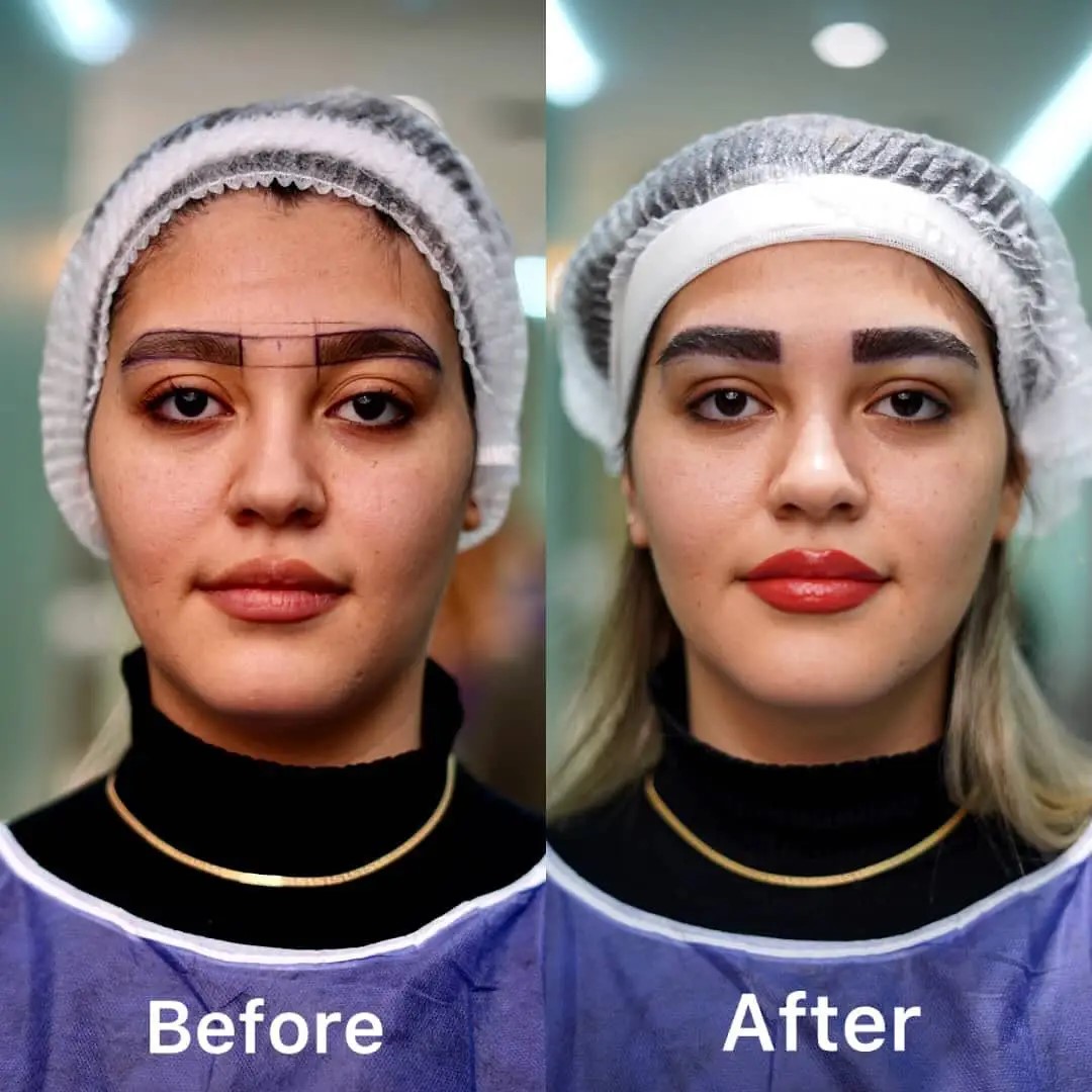 eyebrow before after 
