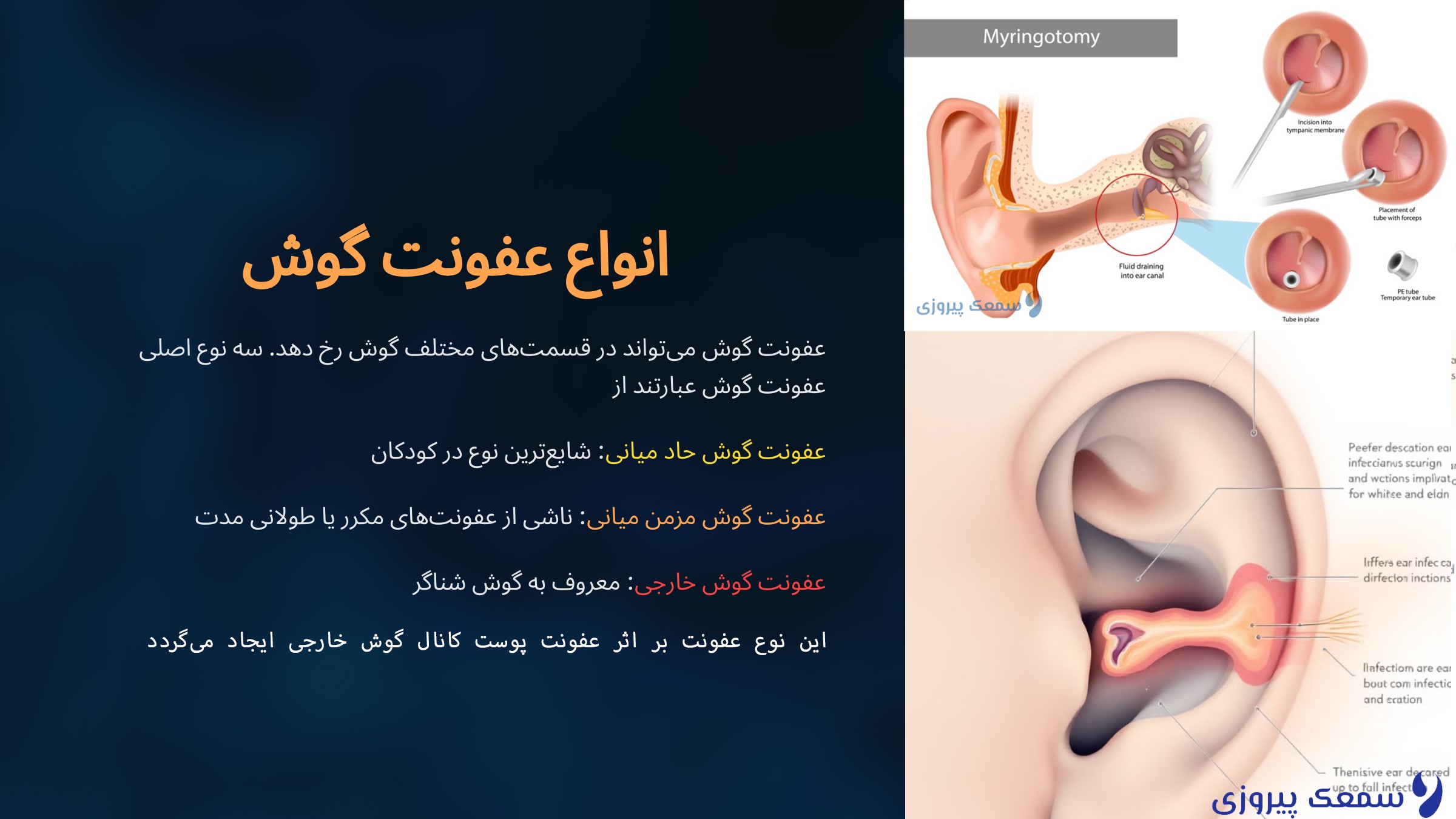 آیا عفونت گوش می‌تواند به کم‌شنوایی کودک شما منجر شود؟(راه های تشخیص+درمان)