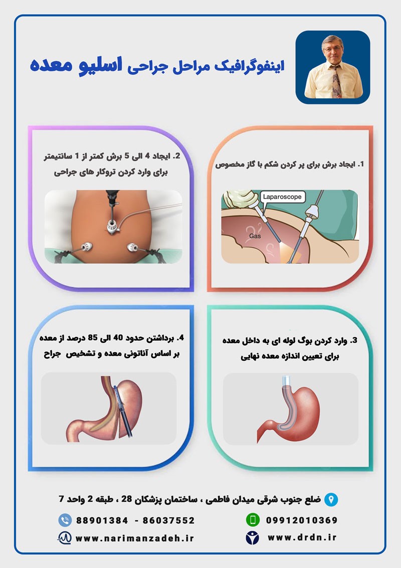 عمل اسلیو معده 