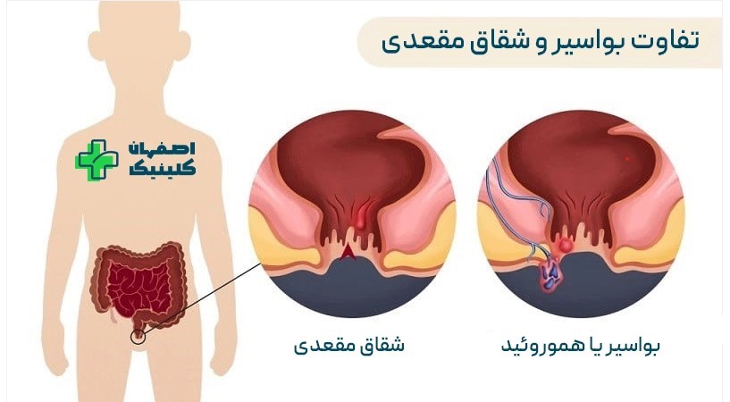 تفاوت شقاق و بواسیر تفاوت در روشهای درمان
