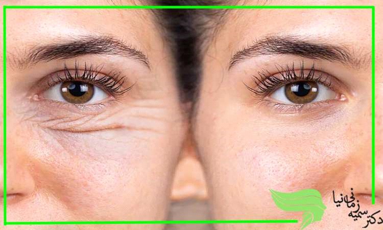 روش دائمی برای حذف افتادگی پلک