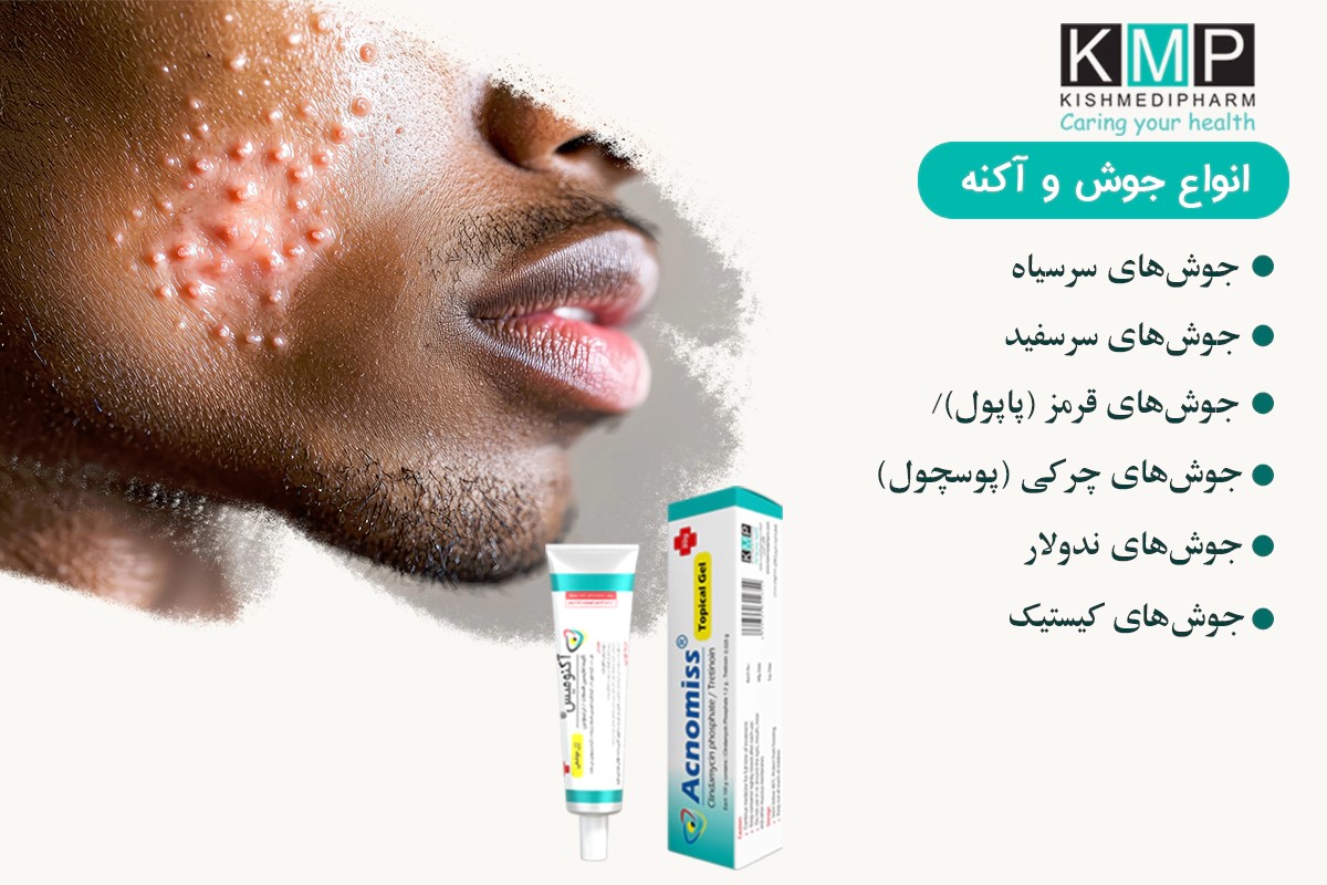 هر آنچه باید در مورد آکنه بدانید و بهترین راه درمان آکنه با ژل آکنومیس