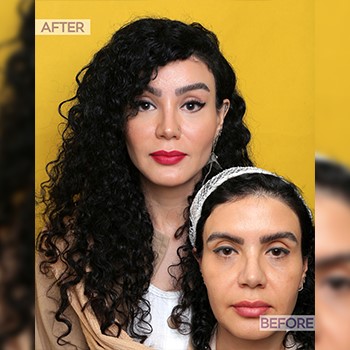 تصویر قبل و بعد از لیفت گونه-کلینیک اکبری