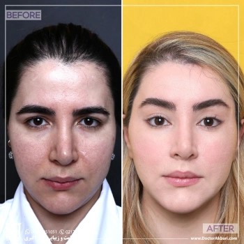 جراحی لیفت شقیقه توسط دکتر طهماسبی