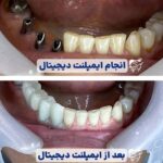 متخصص ایمپلنت دیجیتال در شیراز | هزینه 1404