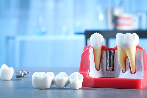 هزینه-ایمپلنت-دندان 
