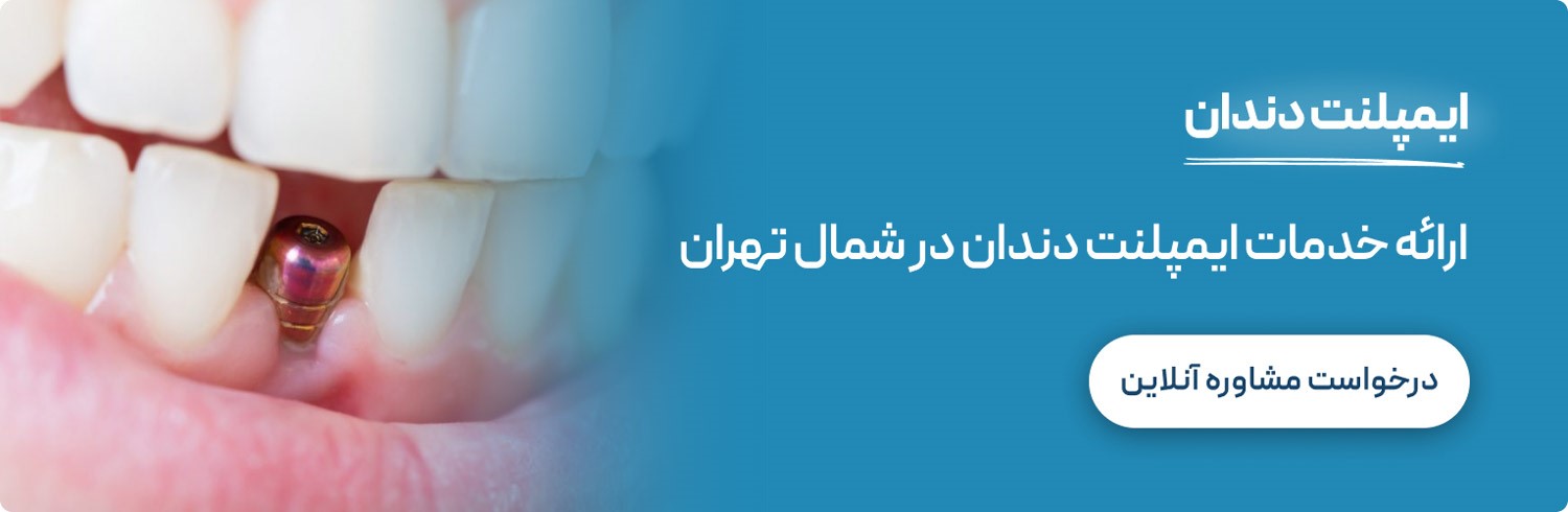 ایمپلنت دندان در تهران