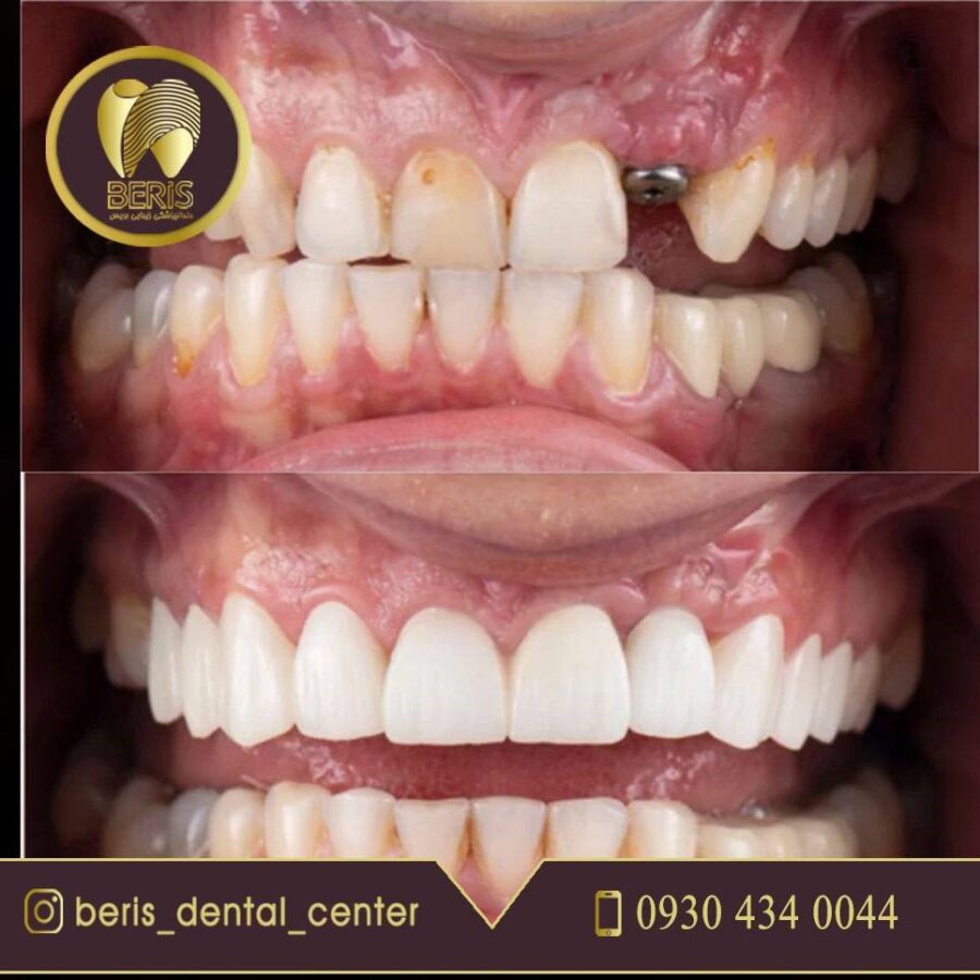 ایمپلنت دندان برای افراد دیابتی + مراقبت های قبل و بعد
