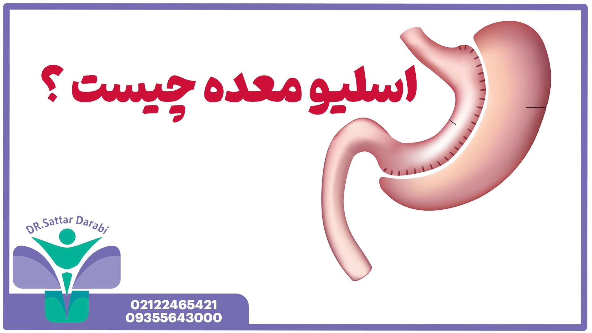 عمل اسلیو معده چیست؟ بررسی جامع جراحی محبوب لاغری