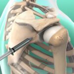 راهنمای کامل درمان شانه یخ زده توسط متخصص ارتوپد