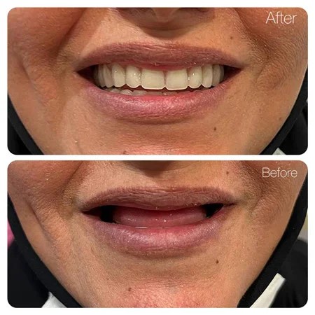 عکس پروتز دندان ژله ای