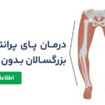 درمان پای پرانتزی در بزرگسالان بدون جراحی