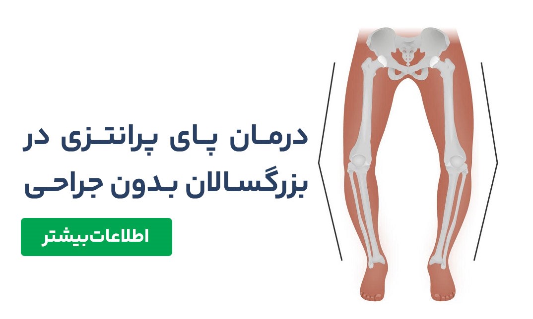 درمان پای پرانتزی در بزرگسالان بدون جراحی