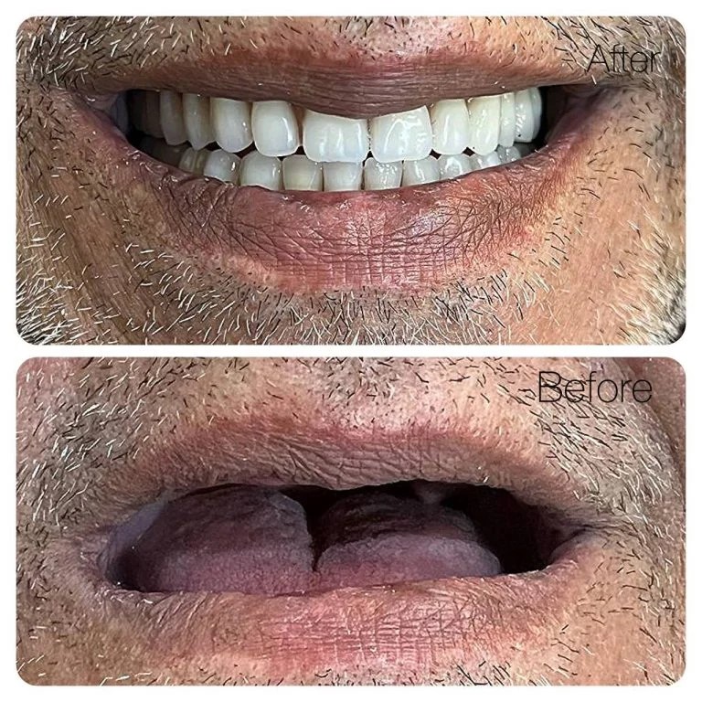عکس چهره با دندان مصنوعی ژله ای