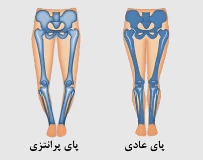 عکس پای پرانتزی