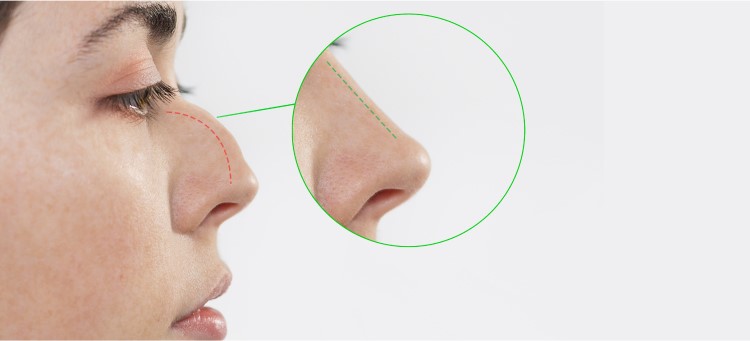 هزینه جراحی بینی دکتر اسدالله پور