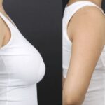 12 روش لیفت سینه و اهمیت انتخاب بهترین جراح لیفت سینه