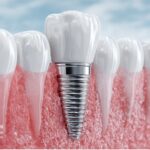 چرا ایمپلنت دندان؟ راهنمای کامل و تخصصی ایمپلنت دندان در ایران