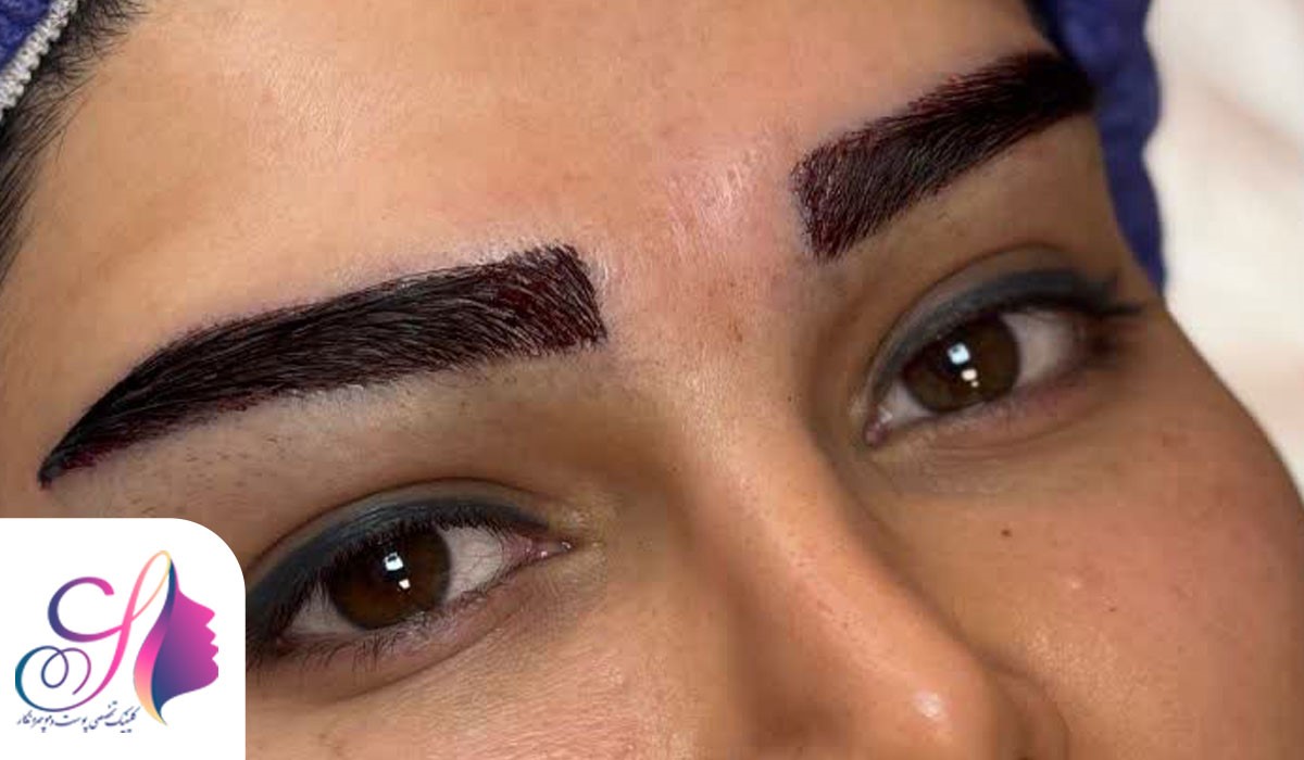 چرا چهره نگار انتخاب اول زیباجویان در تزریق فیلر، بوتاکس و کاشت ابرو است؟ کاشت ابرو با تراکم و فرم دلخواه