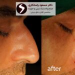 از هزینه تا نتیجه؛ همه آنچه باید پیش از انتخاب عمل بینی بدانید