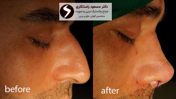 از هزینه تا نتیجه؛ همه آنچه باید پیش از انتخاب عمل بینی بدانید