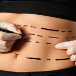 7 مزیت مهم لیپوماتیک نسبت به سایر روش های لاغری【سال1404】❤️