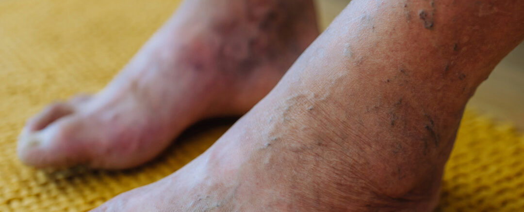 ارتباط نوروپاتی دیابتی و گرفتگی عروق پا