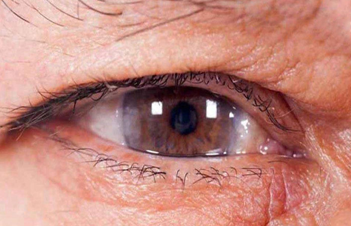 عمل آب مروارید چشم