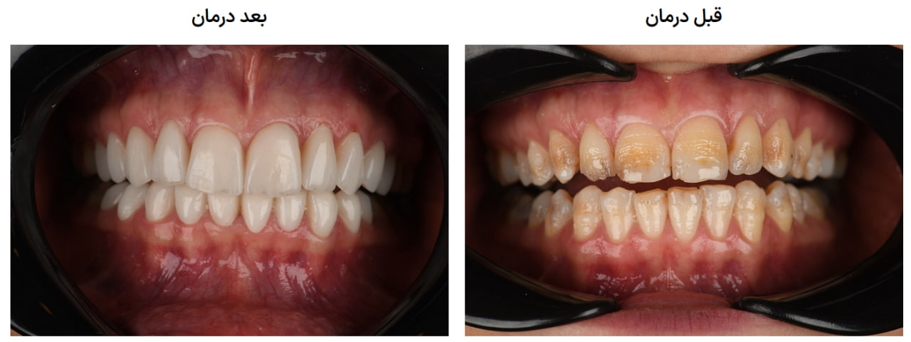کامپوزیت ونیر در کرج