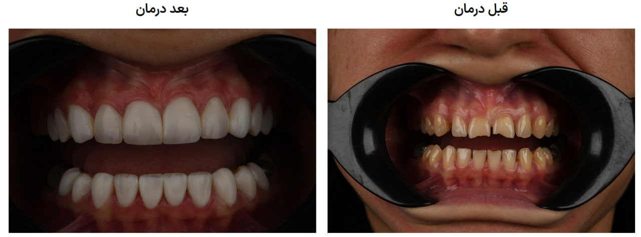 ایمپلنت دندان در کرج