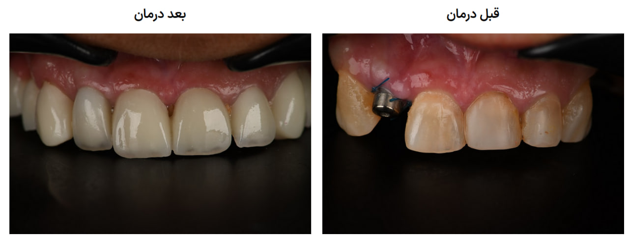 لمینت دندان در کرج