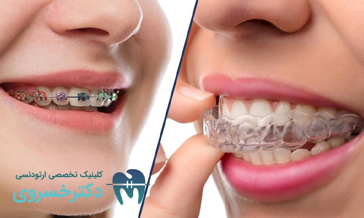 ارتودنسی ثابت؛ پرکاربردترین روش درمانی