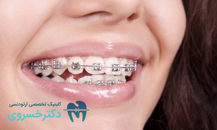مراحل آغاز درمان ارتودنسی برای داشتن دندان های مرتب