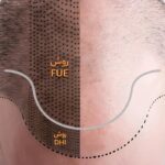 گران ترین روش کاشت مو کدام است؟