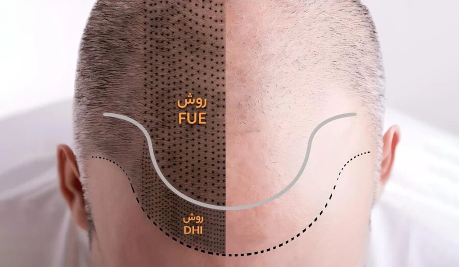 گران ترین روش کاشت مو کدام است؟